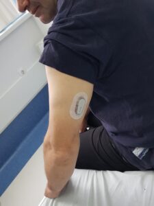 Първият поставен сензор за непрекъснато проследяване на кръвната захар в МБАЛ „Уни Хоспитал“ заработи